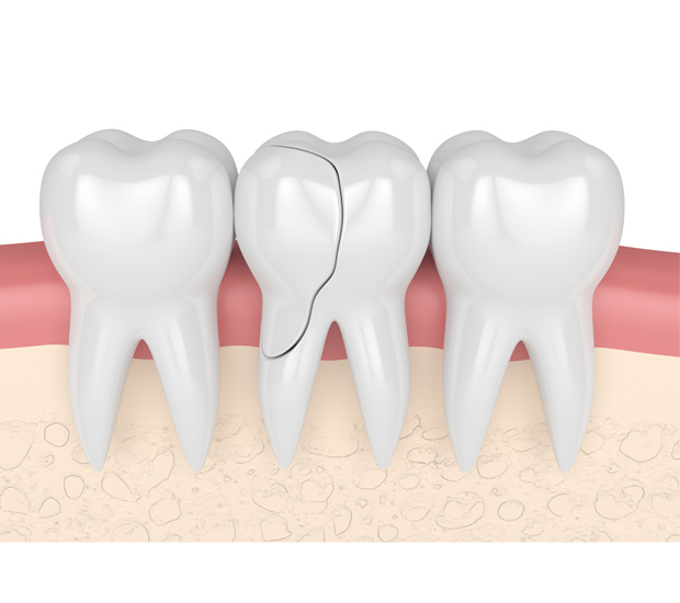 Pittsburg What Should I Do If I Chip My Tooth