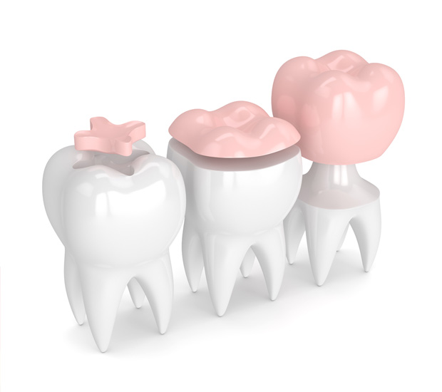 Pittsburg Dental Inlays and Onlays